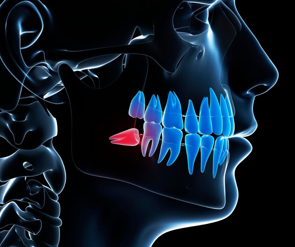 Elevate Oral Surgery - Impacted Teeth
