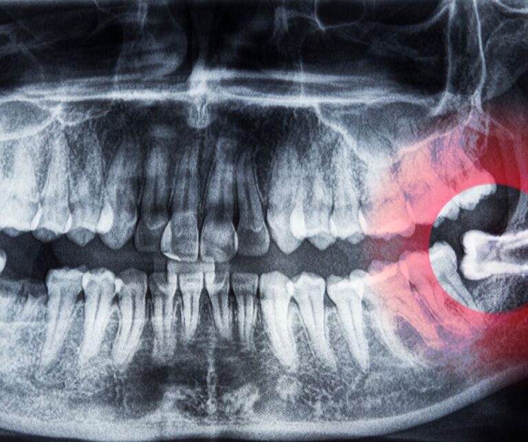 Impacted vs. Erupted Wisdom Teeth - elevateoralsurgery