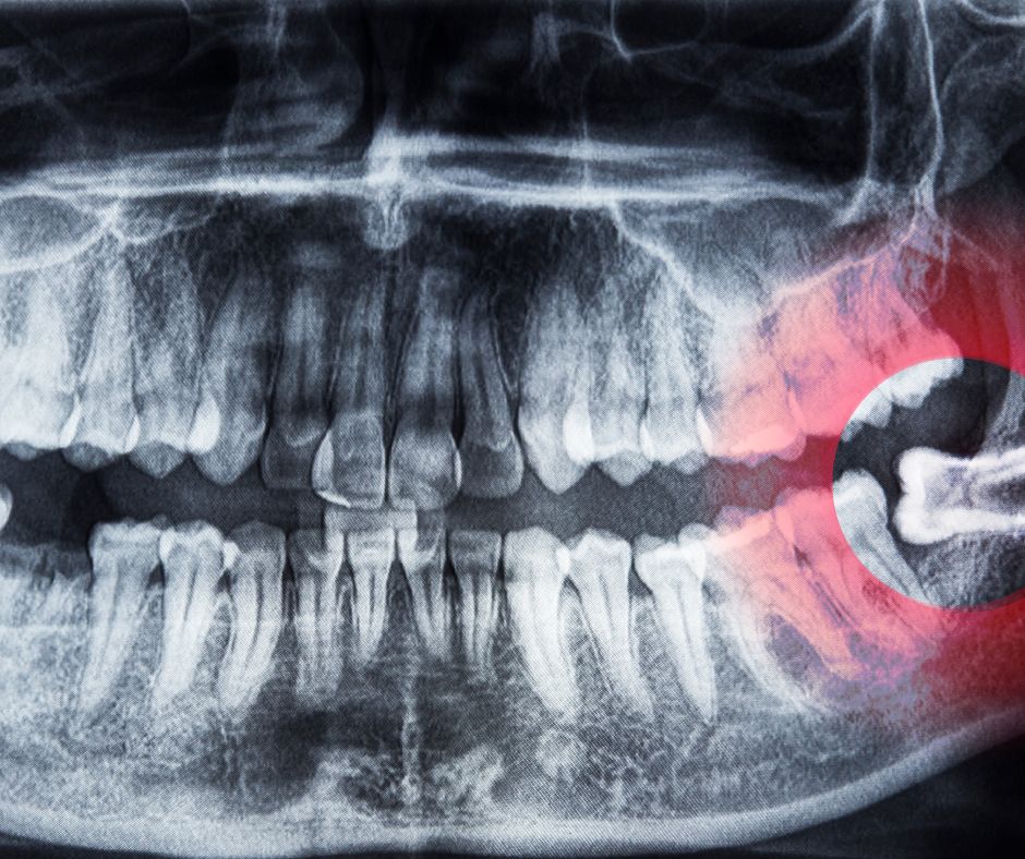 Elevate Oral Surgery - Impacted vs. Erupted Wisdom Teeth