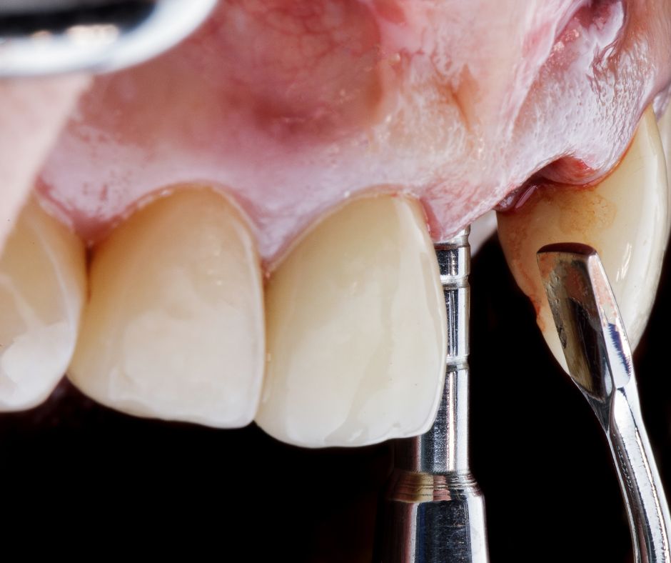 What to Know About Bone Grafting for Dental Implants in Virginia