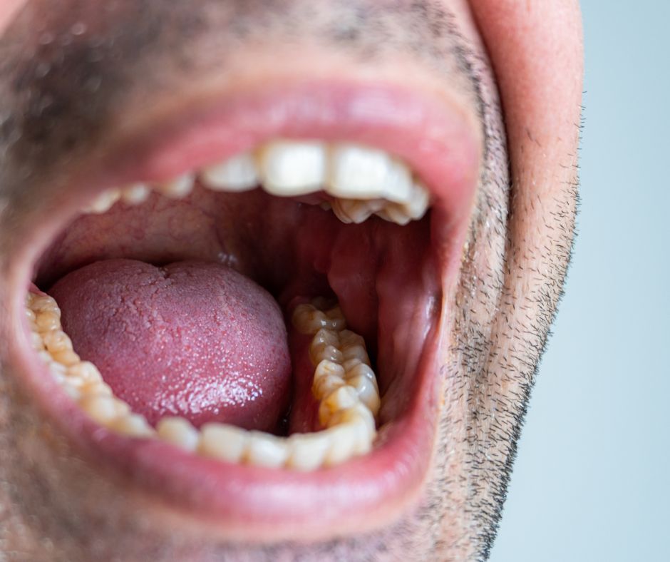 Elevate Oral Surgery - bone loss after tooth removal in Northern Virginia