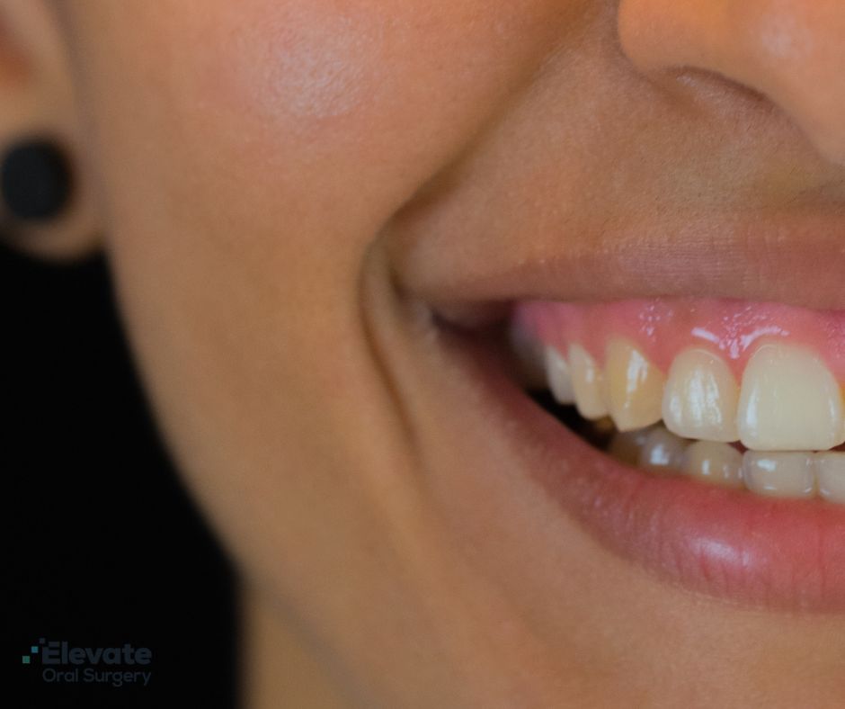 Elevate Oral Surgery - Lip Flip Botox in Fairfax VA