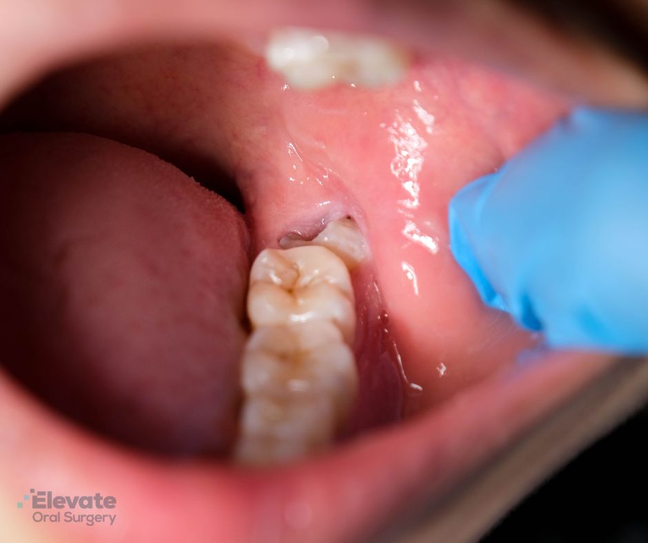 Elevate Oral Surgery - impacted tooth removal in Springfield, VA