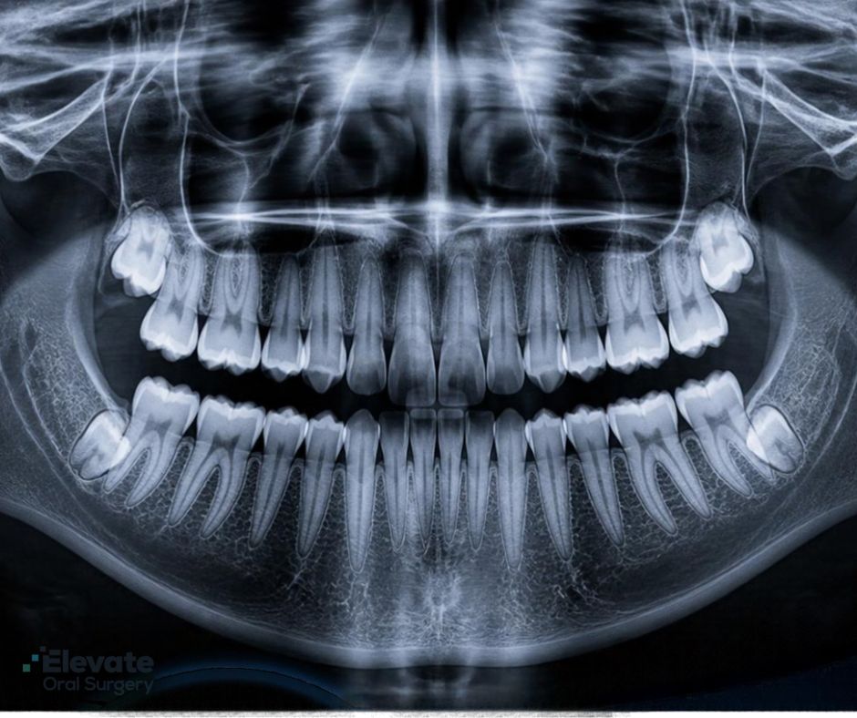 Elevate Oral Surgery - molars vs wisdom teeth oral surgery in Herndon VA